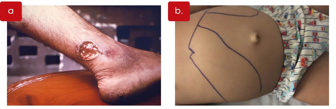 Figura 2. Representações clínicas de leishmaniose. À esquerda (a), imagem de um braço com uma lesão cutânea ulcerada, de bordas elevadas, característica da leishmaniose tegumentar. À direita (b), abdômen de uma criança com aumento visível do volume abdominal, marcado por contornos desenhados com caneta para indicar hepatoesplenomegalia, sinal clássico da leishmaniose visceral. Fonte: OPAS/OMS e OpenWHO por M. Herrero. Imagens CDC/Dr. Mae Melvin.​