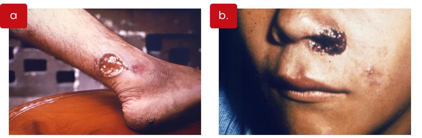 Figura 3. Lesões características de leishmaniose tegumentar. À esquerda (a), úlcera arredondada com bordas elevadas localizada no tornozelo de uma pessoa. À direita (b), lesão escurecida e crostosa acometendo a mucosa nasal de um paciente. Fonte: CDC/Dr. Mae Melvin.​​