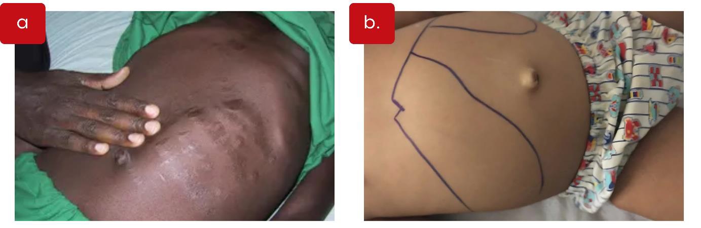 Figura 4. Hepatoesplenomegalia na leishmaniose visceral. Imagem (a) mostra um abdome de paciente com pele escura, com aumento visível de volume, sendo palpado na região superior esquerda. Imagem (b) mostra o abdome de uma criança com contornos desenhados sobre a pele, indicando o aumento do fígado e do baço. Fonte: OPAS/OMS e OpenWHO por M. Herrero. Imagens CDC/Dr. Mae Melvin.​