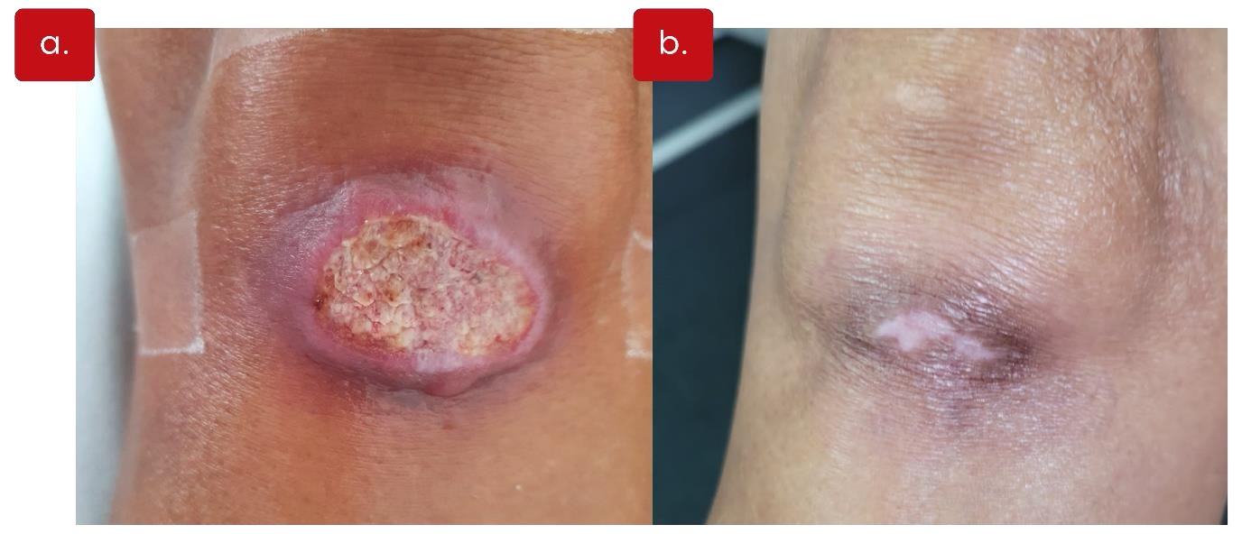 Fotografia composta de duas imagens lado a lado mostrando lesões na pele causadas por leishmaniose cutânea. À esquerda (a), observa-se uma lesão ativa: uma úlcera com bordas elevadas, avermelhadas e centro com tecido esbranquiçado e irregular. À direita (b), visualiza-se a cicatriz da lesão: área de pele mais clara e lisa com leve retração e coloração hipopigmentada no centro da antiga úlcera. Fonte: Jaqueline de Souza / Fiocruz Minas.​