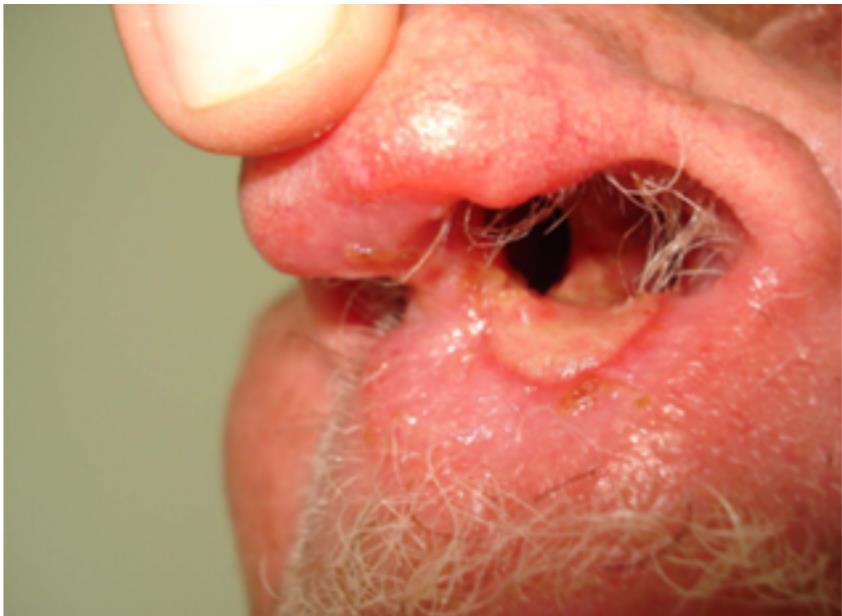 Fotografia em close de região nasal de um paciente com lesão ulcerosa. Observa-se ulceração na mucosa do septo nasal e na borda das narinas, com perda de tecido e aspecto avermelhado. Há presença de pelos ao redor da lesão e leve inflamação na pele adjacente. Fonte: UNIVERSIDADE ABERTA DO SUS (UNASUS). Módulo 2: Saúde Pública e Vigilância. Brasília: UNA-SUS, 2024. Acesso em: 23 dez. 2024.​